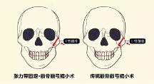 联合丽格第 一医院何照华院长：张力带固定颧骨内推与传统颧骨手术有何区别？