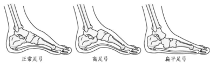 儿童足弓发育关键期，出现严重扁平足及时穿着矫正鞋干预