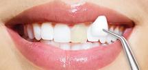 厦门牙齿贴面多少钱？美莱牙齿贴面能维持多久？